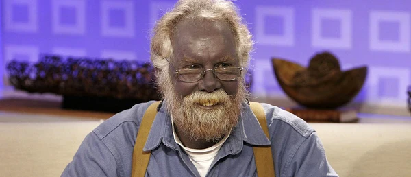 silver allergy